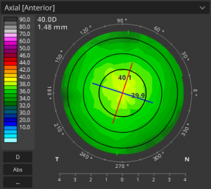 TOPOGRAPHY normal - BiB Ophthalmic Instruments | BiB Ophthalmic ...